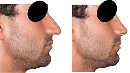 Un nez harmonieux avec la rhinoplastie esthétique