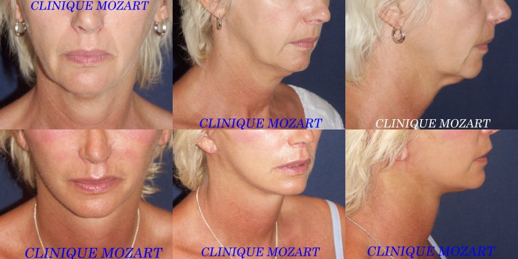 lifting cervico facial