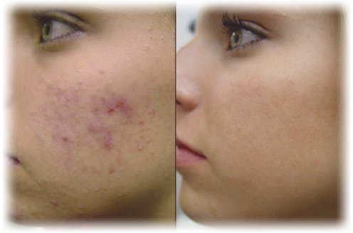 L'acné, traitements, les idées recues a propos de l'acné