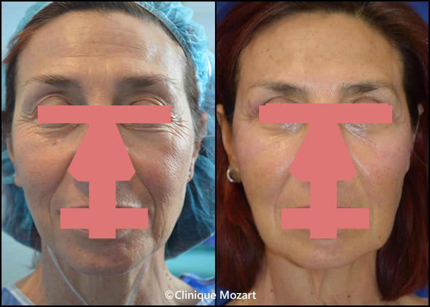 laser fractionne resurfacing