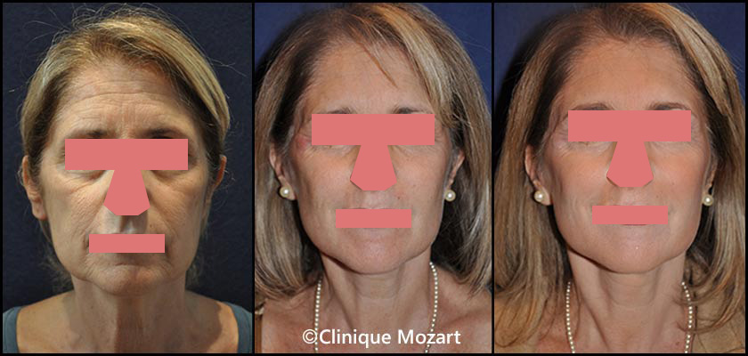 laser fractionne resurfacing